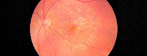 Macular Degeneration Treatment - Raghunand Sastry MD