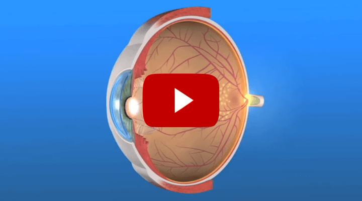 Diabetic Retinopathy (Explainer video.)