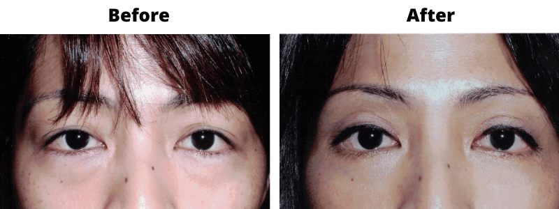 Upper Lower Blepharoplasty