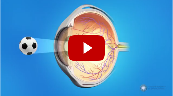 What Are Cataracts?