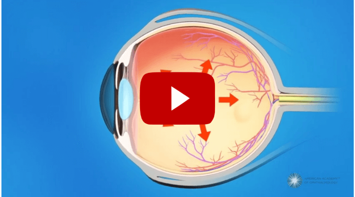 What Is Glaucoma (Explainer Video)