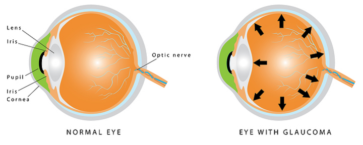 What Is Glaucoma?