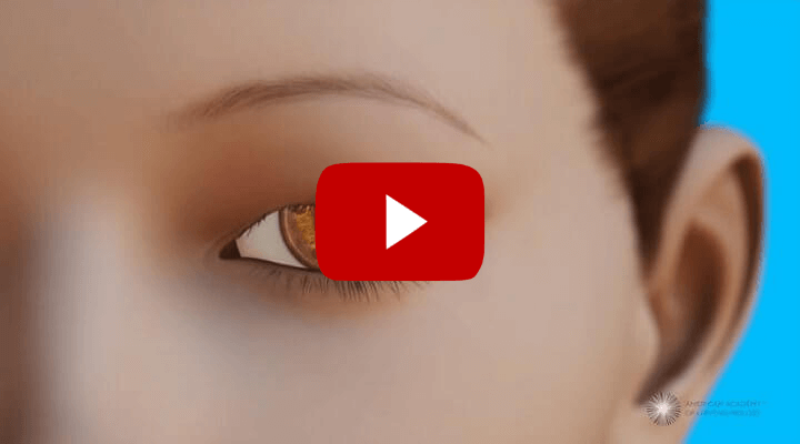 Blepharoplasty (Explainer video.)