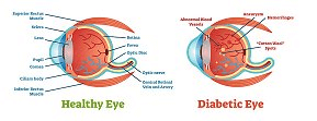 Diabetic Retinopathy Treatment - Raghunand Sastry MD