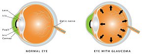 Glaucoma Treatment - Raghunand Sastry MD